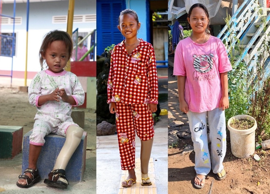 Channa, qui a bénéficié d’une prothèse de Handicap International, photographiée à différents moments de sa vie 
